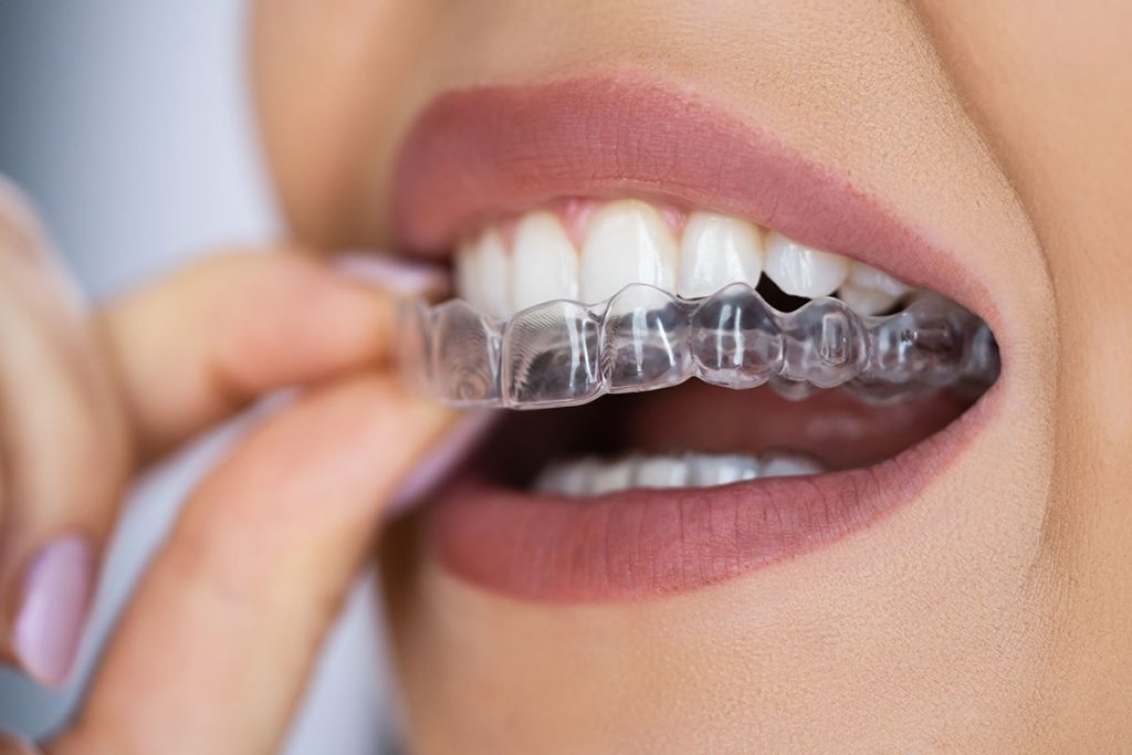 Produktbild von BRITX 2 Dental Mundschutz Gegen Zähneknirschen – Formbar, Lebensmittelecht, Für Nachts